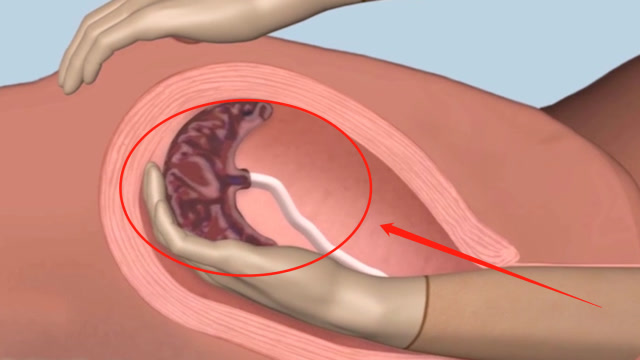 真人手剥胎盘图片分娩图片
