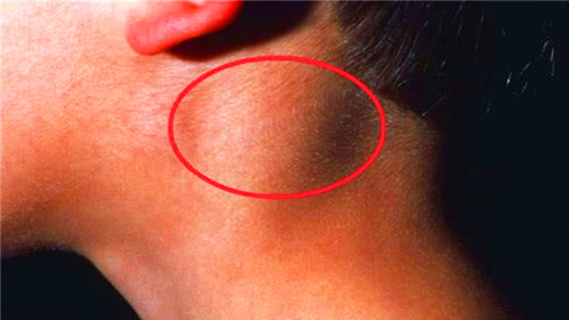 艾滋病早期脖子图图片