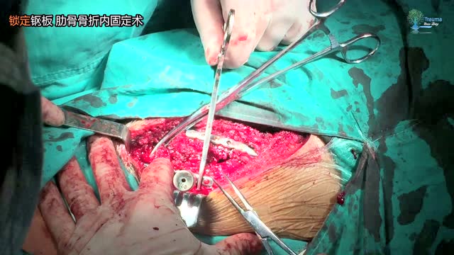 锁定钢板肋骨骨折内固定术