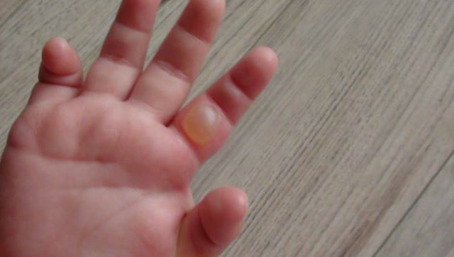 两岁儿童满手水泡,这个东西千万不能摸!