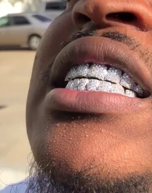 一口牙都镶钻,这真是家里有矿啊,有钱人的世界,我真的有点儿不懂