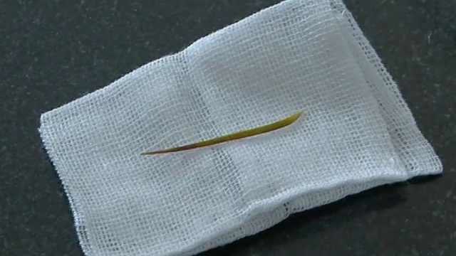 男子腹痛取出一根4厘米鱼刺,肠道被刺穿:被鱼刺卡住就生吞