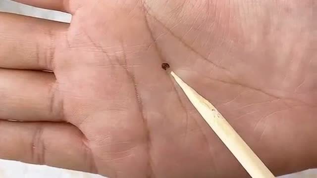 扎刺了在手掌心取不出来咋办,教你一招就能轻松搞定,看完你学会了吗?