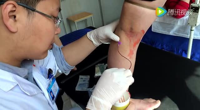 静脉注射针头委中放血