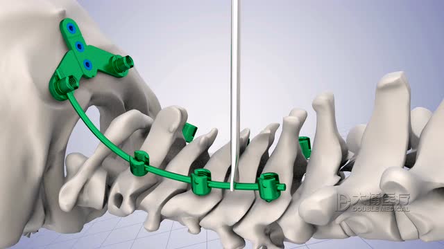 大博医疗颈椎后路固定系统