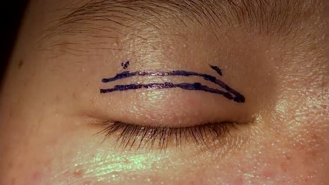 yjf:重睑画线去皮2