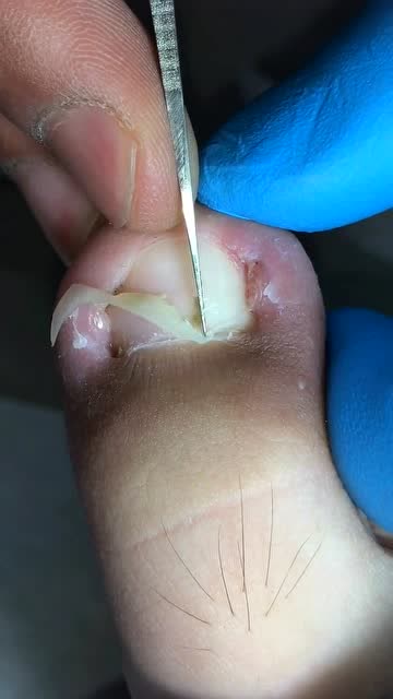 实拍治疗甲沟炎嵌甲太深了挖出来疼的哎呀了一声