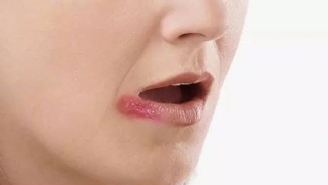 为什么有些人一上火,嘴角就起水泡?听听口腔科医生怎么说