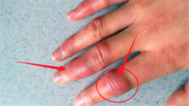 肺癌一发现就是晚期,一旦手指出现这3个信号,说明离你不远了!