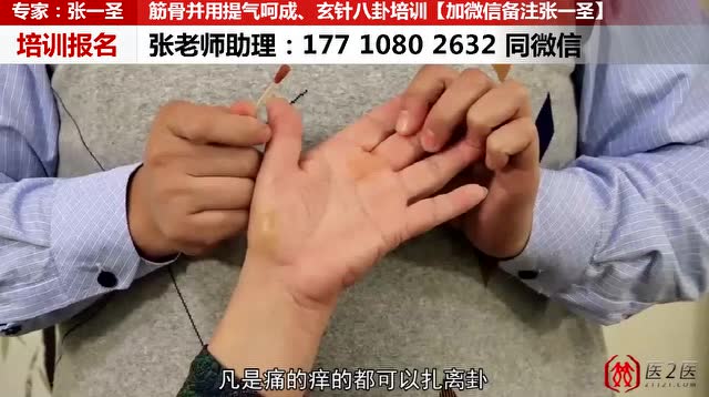 张一圣八卦玄针治疗坐骨神经痛