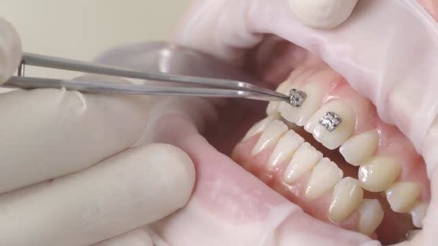 牙齿矫正托槽是怎么粘到牙齿上的呢真实拍摄