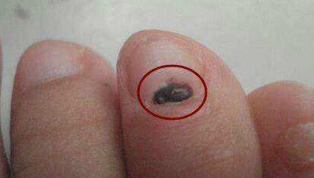 指甲上出现这种条纹,不用怀疑,癌症来了,晚了医生也救不了你