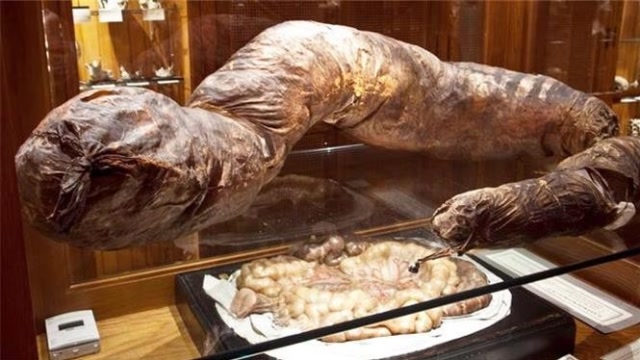 世界上第一个被憋死的人,3年没有上厕所,肠子重达36斤!