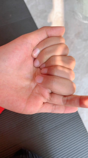 从小长了八根手指头,同学们都笑话我!