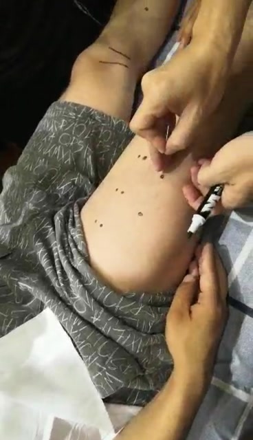 董事针灸足驷马通肾穴进针方法