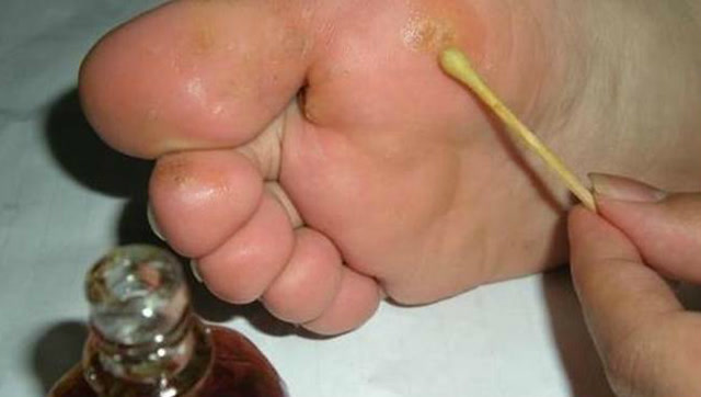 冬天脚气发病太臭了!把1种常见药磨成粉擦脚,这样弄就行了