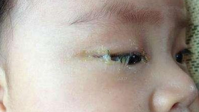 儿童眼睛红有眼屎图片图片