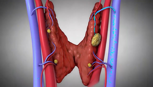 3d动画演示甲状旁腺功能亢进病理,知其然还要知其所以然