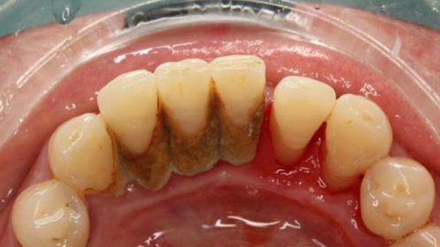 还在花钱洗牙么?教你土方法,在家轻松搞定牙菌斑,牙齿更洁白!