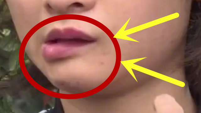 美女贷款4万整容,嘴巴却"歪"了,事后称:"我没整之前都好看的要死"