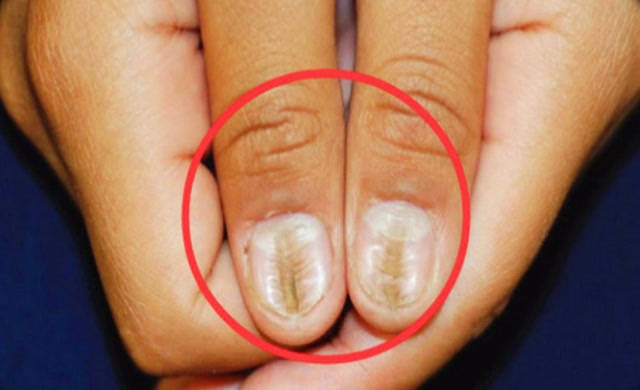 肝癌手指的变化图片图片
