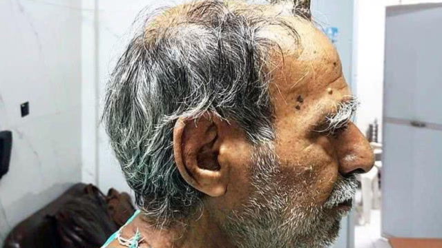 七旬老人头上长出"魔鬼之角"!长达10cm