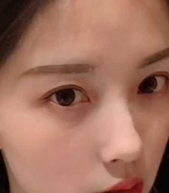 真人案例揭秘:迷你拉皮术效果