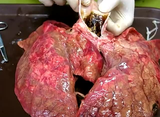 实拍香烟进入到肺里的全过程!看完就别再继续抽了