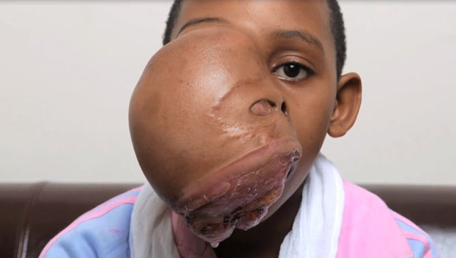 女子患怪病嘴巴长巨大肿瘤