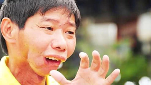 槟榔加烟法力无边?槟榔吃多了,小心到时候要割脸保命!