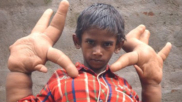 印度12岁男孩,长出30厘米巨大手掌,医学也无法解释!