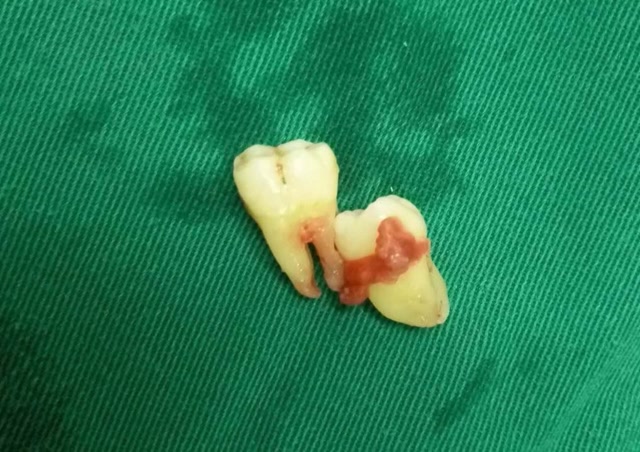 如果把牙神经拔掉会怎么样?