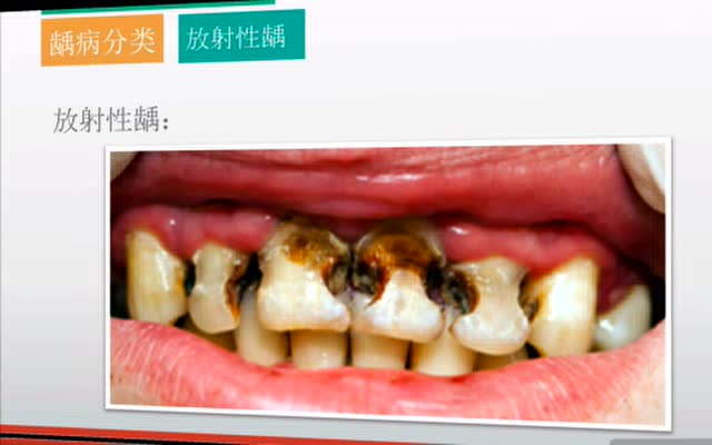 6 继发龋,猖獗龋及放射性龋
