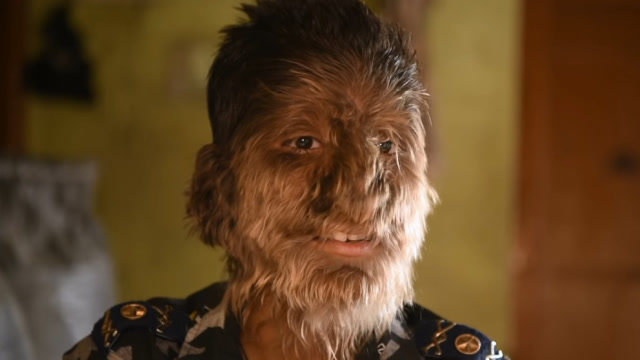 13岁印度男孩被称狼人,脸上布满长毛,科学家也无法解释