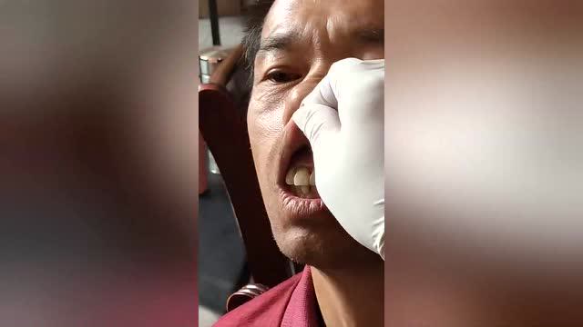 刘涛龈交穴治疗痔疮