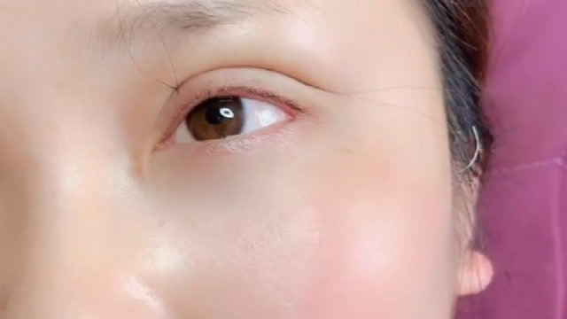 双眼皮压线真实过程,这线跟头发丝一样细,真是想不到