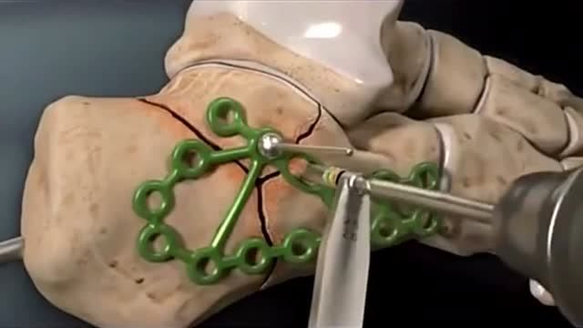 骨头裂缝固定的过程,需要把里面打上钢钉,科技发达看着还是恐惧!
