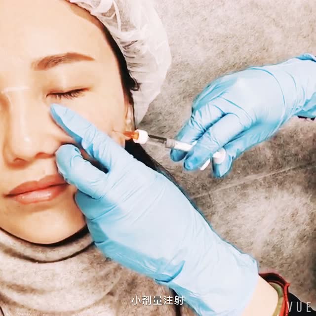 高颜医美诊所 - 注射美容之泪沟填充治疗