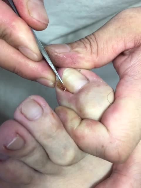 实拍修脚师傅怎么处理甲沟炎看着就疼啊啊啊