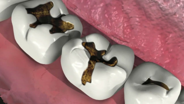 蛀牙是如何形成的真是蚜虫咬的吗看完终于懂了