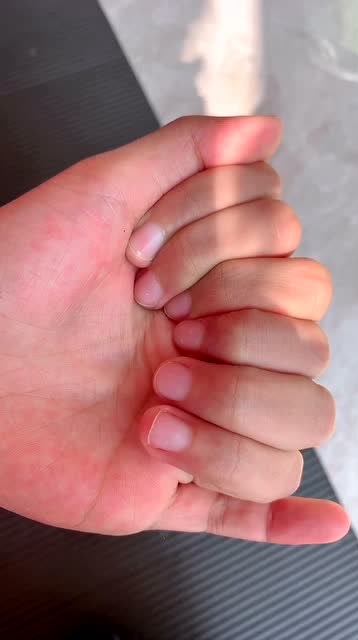 从小长了八根手指头,同学们都笑话我!