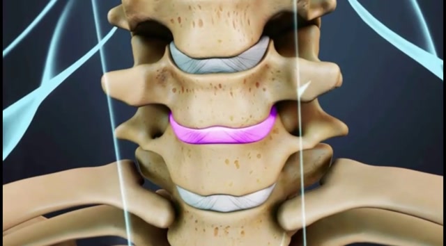 腰椎间盘突出3d演示