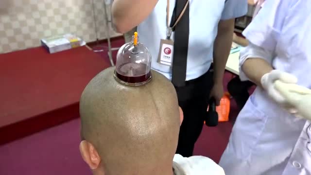 王合民刺络放血疗法-百会放血治疗多种疾病,静脉曲张的治疗