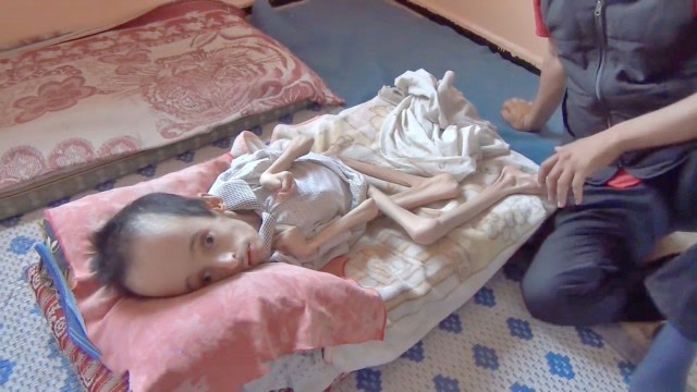 20岁男子瘦骨如柴四肢严重扭曲,原因让人想不到,看了让人心酸