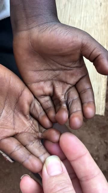 非洲手指粘连的4岁男孩,好可怜,这一幕我潸然泪下!