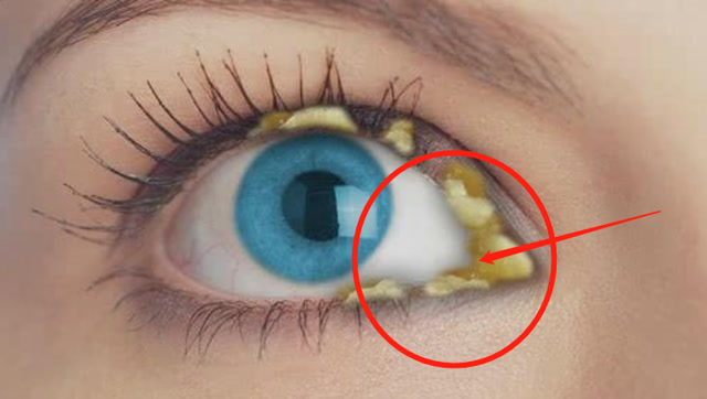 人晚上都是闭着眼睡觉,为什么还会有眼屎?听听专家的说法