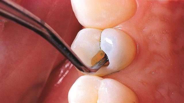 蛀牙真的是被虫子吃光的吗?全程3d模拟了解真相,再也不要不注重了