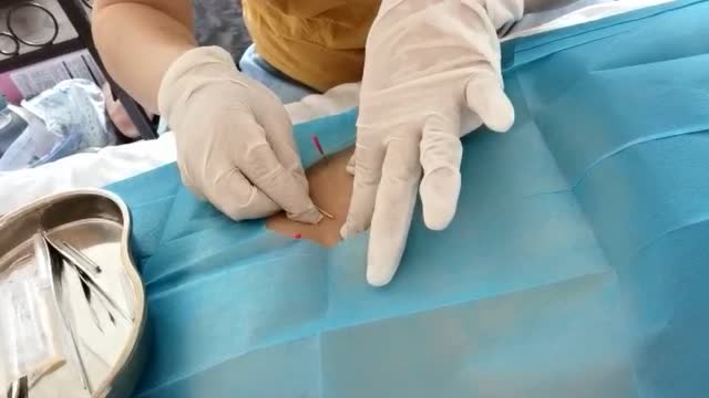 聚医康-王阿萍针灸乳腺增生