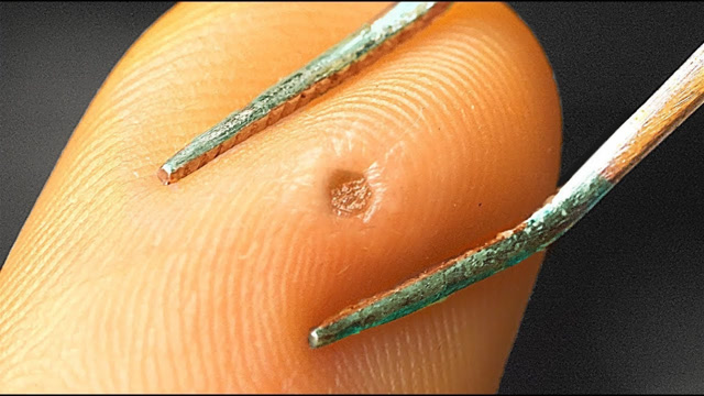 你的粉刺里有什么?显微镜下最美的痘痘,里面藏着一个宇宙