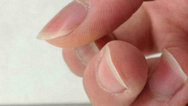 指甲突然变成"汤勺状",是贫血的先兆!不要不在乎!